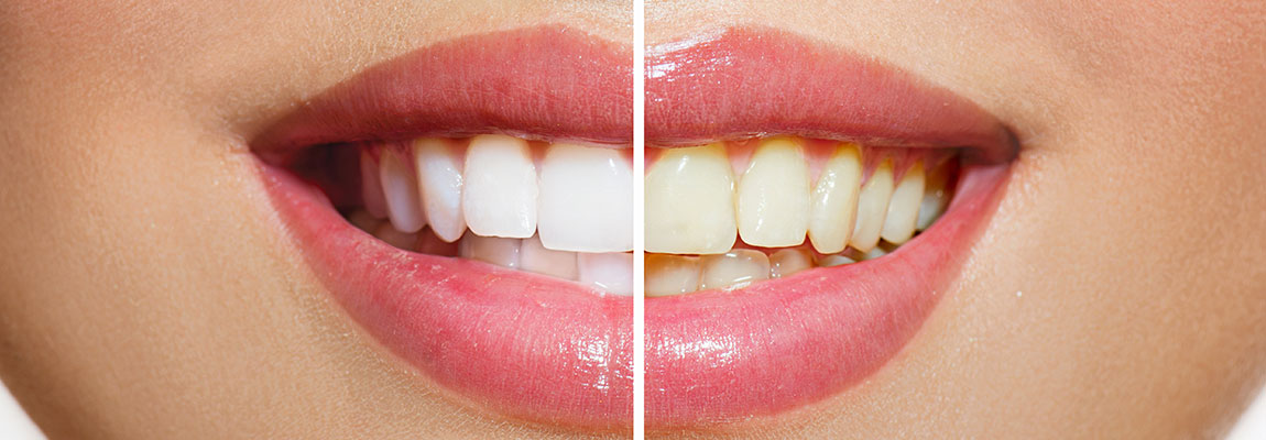 Kosmetische Zahnaufhellung